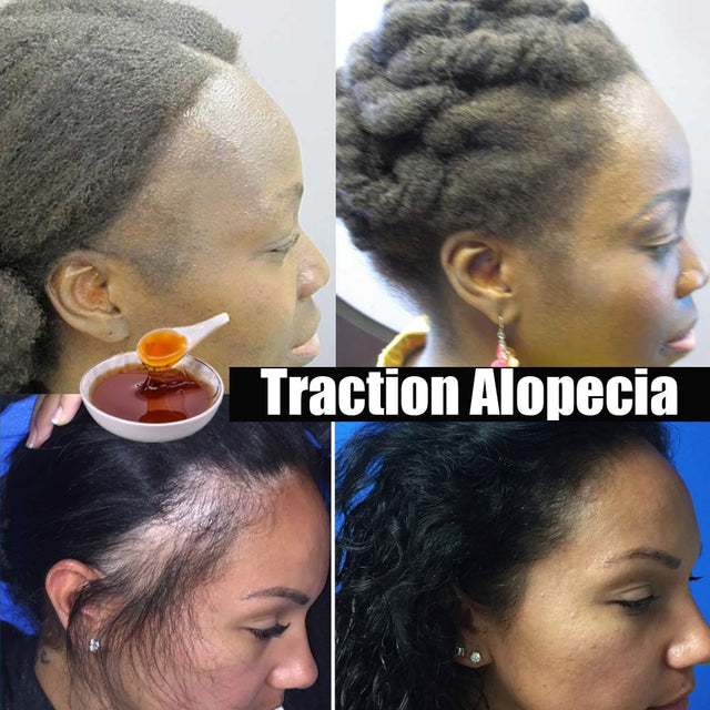 Collage of a woman with traction alopecia and a bowl of honey, with text 'Traction Alopecia'.