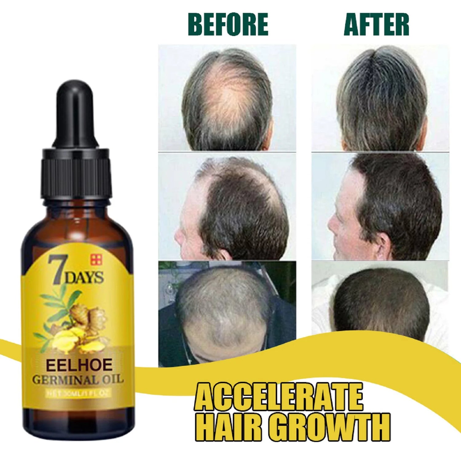 Bottle of 7 Days Eelhoe Germinal Oil with 'Before' and 'After' hair growth results on a white background.