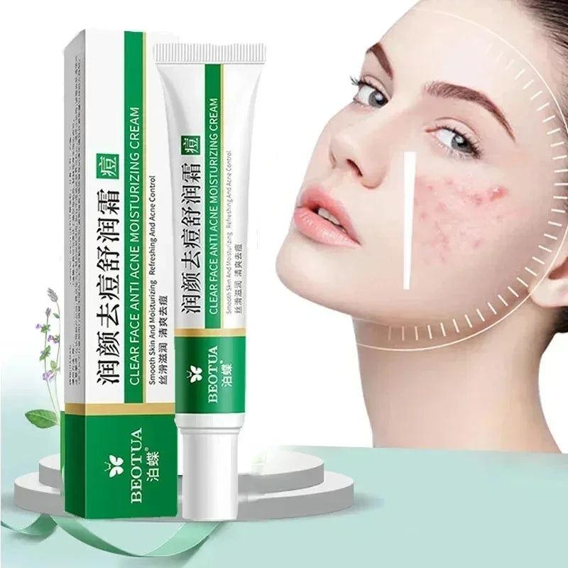 Facial cream with packaging and a woman's face showing acne on a light green background