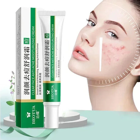 Facial cream with packaging and a woman's face showing acne on a light green background