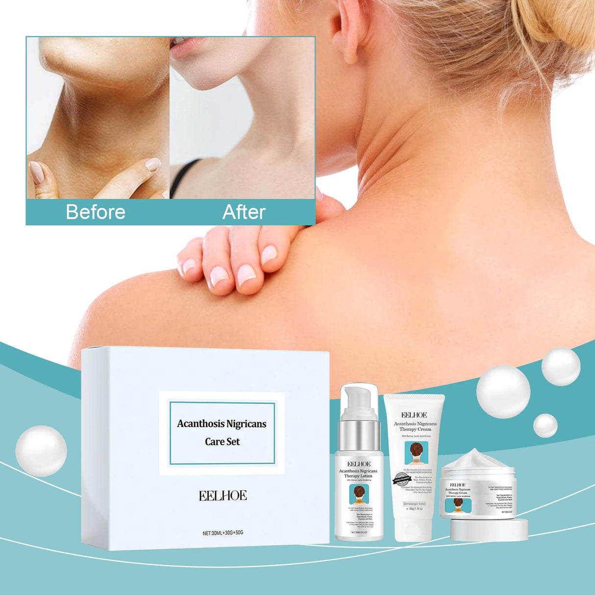Eelhoe Acanthosis Nigricans Care Set with 'Before' and 'After' comparison on a woman's neck.