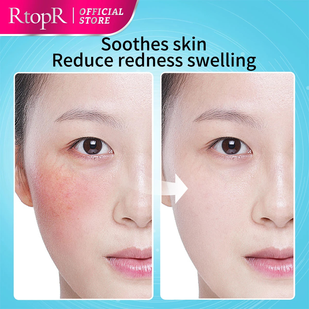 Before and after comparison of a person's face with redness, showing the product's effect on skin.