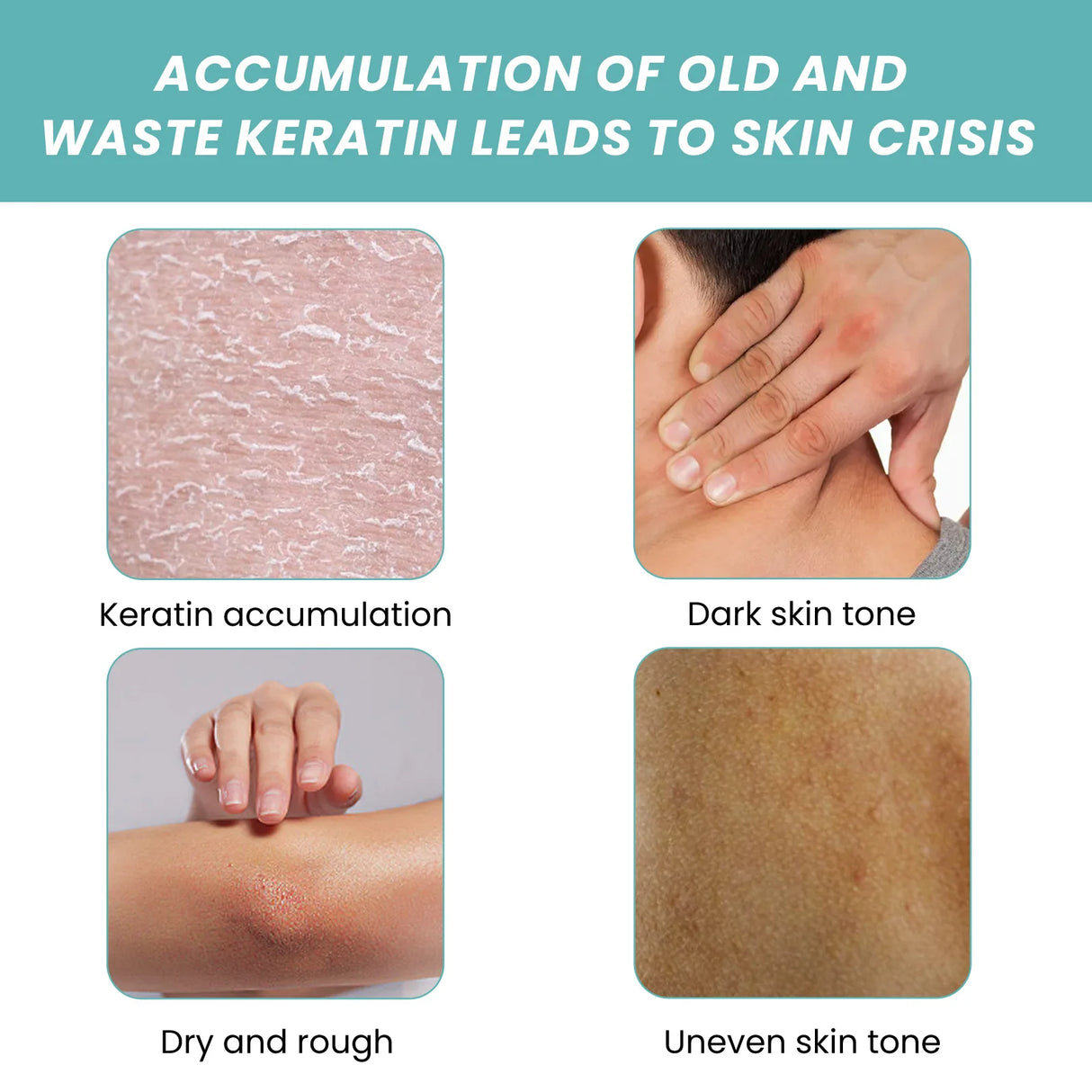 Illustration showing keratin accumulation, dark skin tone, dry and rough skin, and uneven skin tone with text about skin crisis.