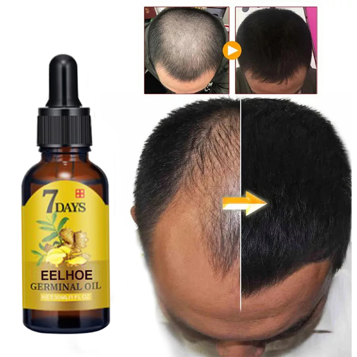Bottle of 7 Days Eelhoe Germinal Oil with before and after hair growth comparison on a white background