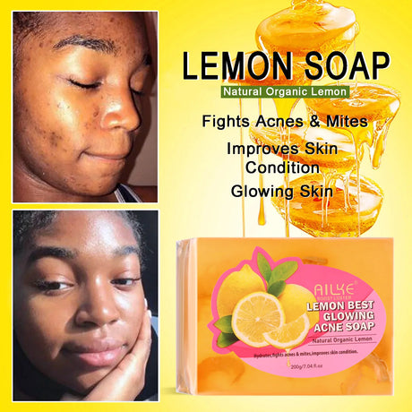 Advertisement for Alke Lemon Best Glowing Acne Soap with before and after effects on skin.