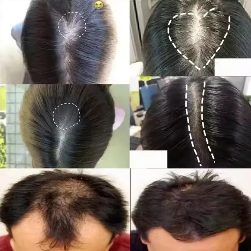 Collage of images showing hair loss and regrowth on a person's head.