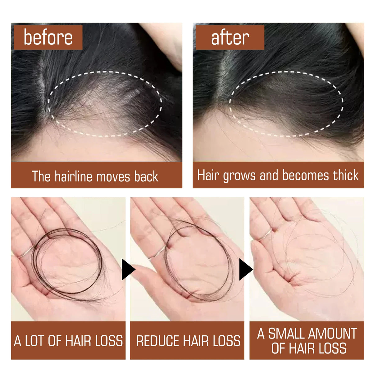 Before and after comparison of hairline movement and hair growth with a focus on hair loss reduction.