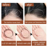Before and after comparison of hairline movement and hair growth with a focus on hair loss reduction.