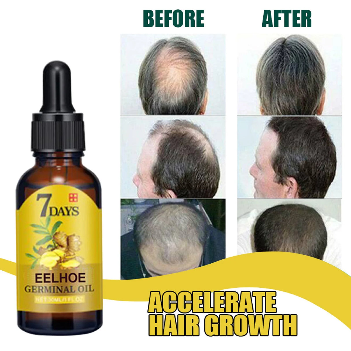 Bottle of 7 Days Eelhoe Germinal Oil with 'Before' and 'After' hair growth results on a white background.