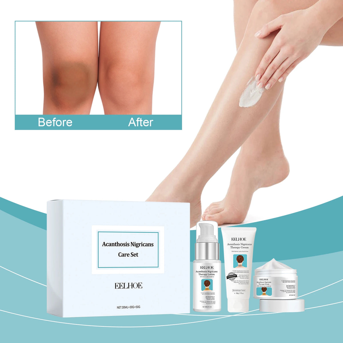 Acanthosis Nigricans Skin Repair and Whitening Set before and after leg comparison showing dark patch reduction.