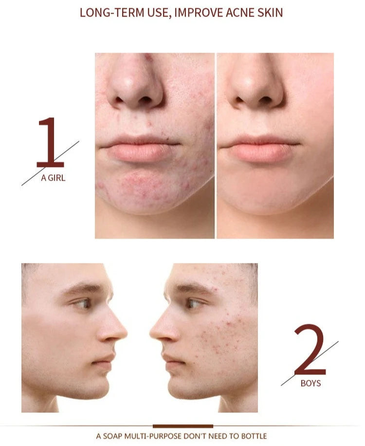 Tibetan Herbal Handmade Black Soap before and after acne treatment comparison showing clearer skin on face.