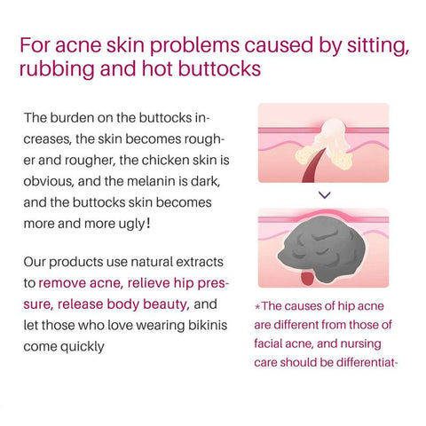 Butt Acne Clearing Cream