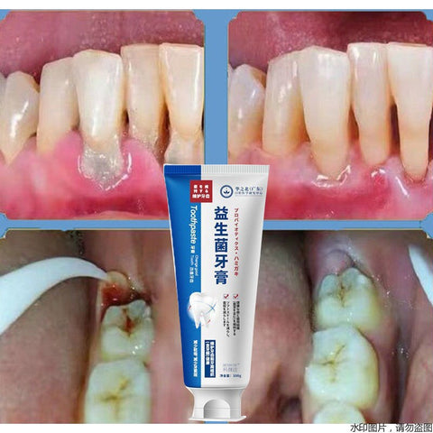 Teeth Cavities Removal