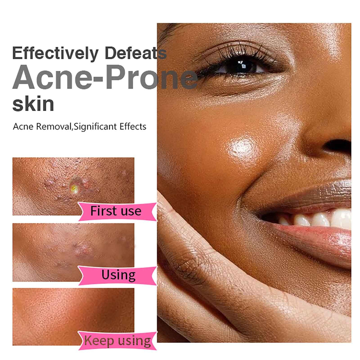 AILKE Organic Salicylic Acid Acne Cream ingredients label showing salicylic acid and allantoin formula.