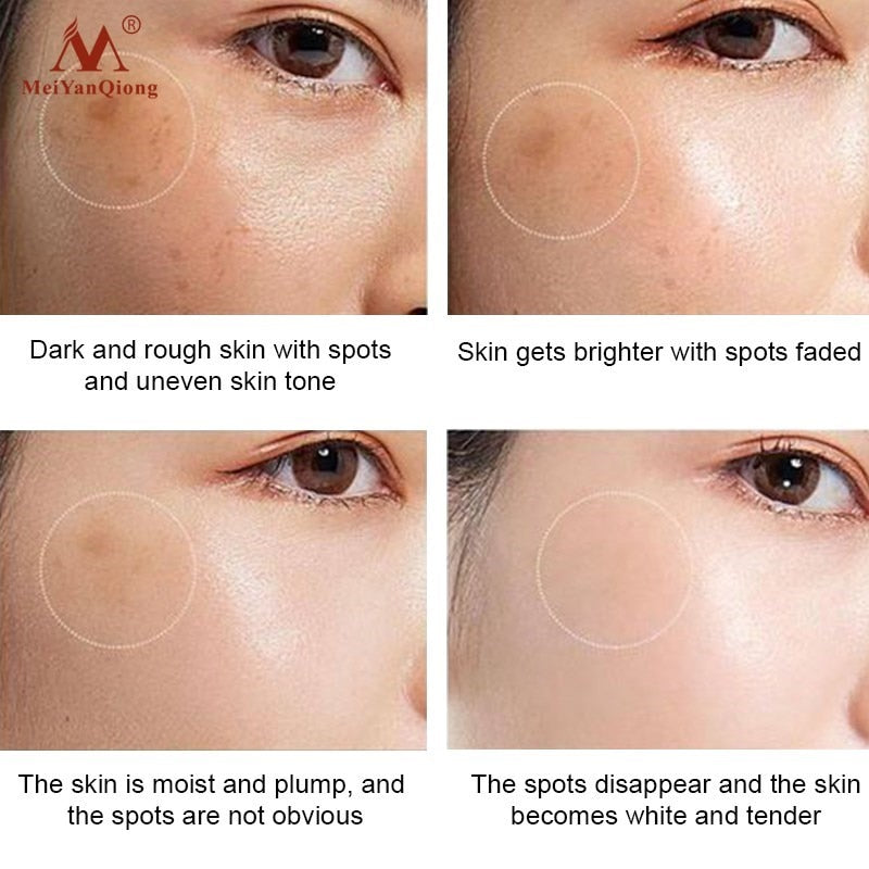 Mei YanQiong Dark Spot Remover Cream dark spot fading and brightening results display.