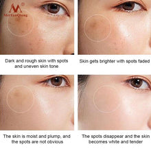 Mei YanQiong Dark Spot Remover Cream dark spot fading and brightening results display.
